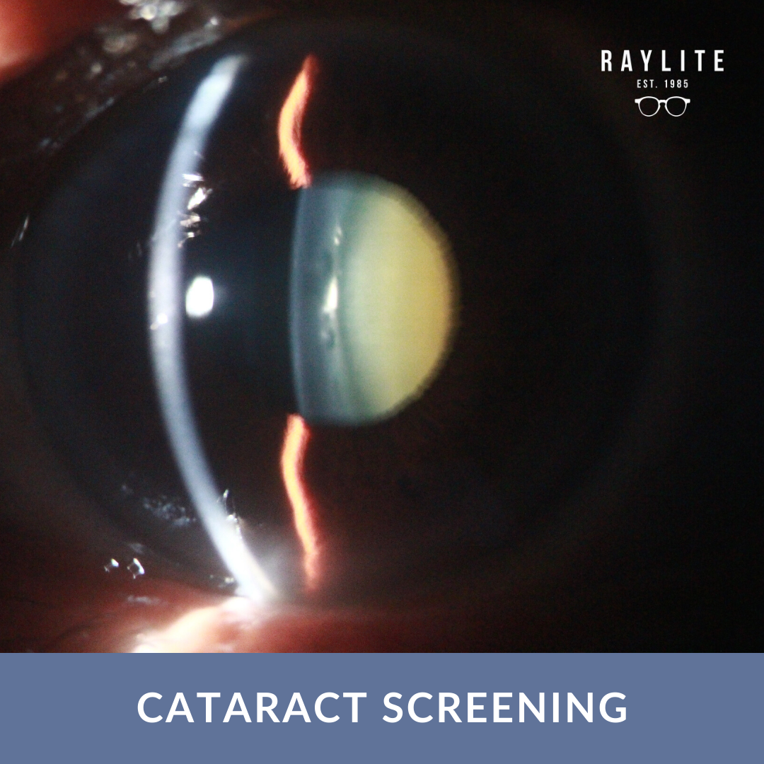 Cataract Screening (Adults) Book Online Raylite Optical Raylite